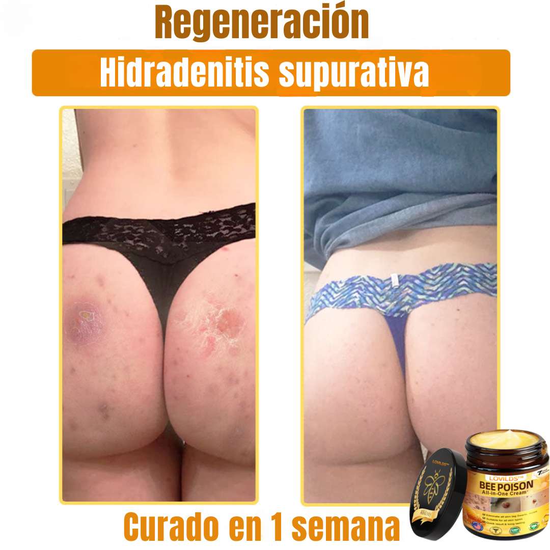 LOVILDS™ Bee Poison Cream  – Potencia natural para tu piel 🌿