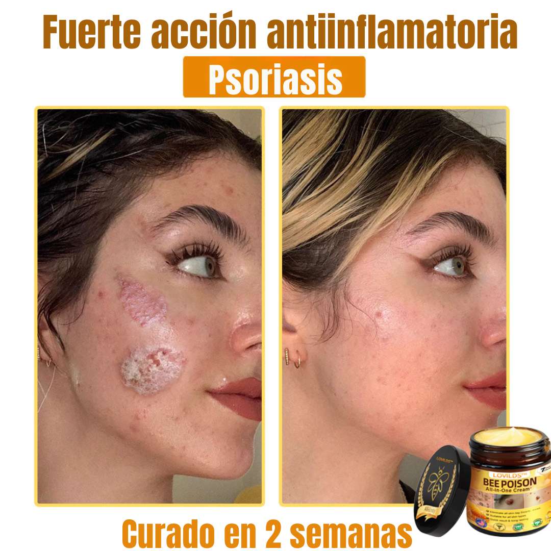 LOVILDS™ Bee Poison Cream  – Potencia natural para tu piel 🌿