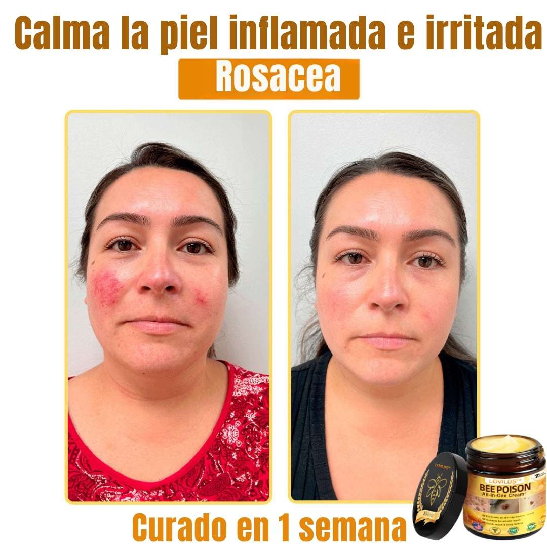 LOVILDS™ Bee Poison Cream  – Potencia natural para tu piel 🌿